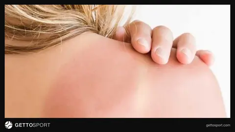 Güneş yanığına uygulanan soğuk kompres ve aloe vera jeli